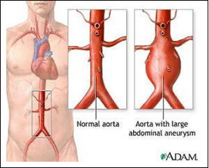 腹主动脉瘤- 胸痛, 主动脉, 动脉硬化, 高血压, 血