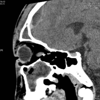 14歲男孩　鼻竇炎合併眼窩及腦部膿瘍