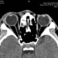 14歲男孩　鼻竇炎合併眼窩及腦部膿瘍