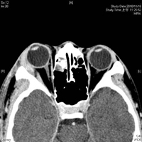 14歲男孩　鼻竇炎合併眼窩及腦部膿瘍