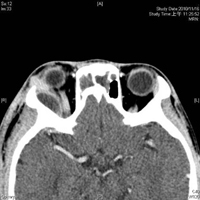 14歲男孩　鼻竇炎合併眼窩及腦部膿瘍