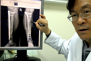 骨折病人使用微創手術傷口小、恢復快　降低感染風險