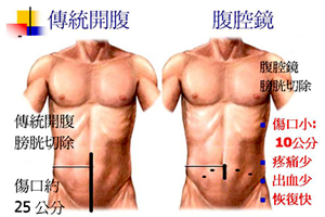 無痛血尿演變成膀胱癌　腹腔鏡膀胱切除術新選擇