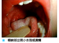 天天洗手病菌快走　腸病毒遠離我！