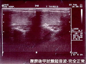 年輕女子脖子腫脹亞急性甲狀腺炎上身