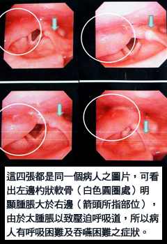 喉嚨痛吞嚥困難及呼吸困難，小心有可能是致命性會厭炎