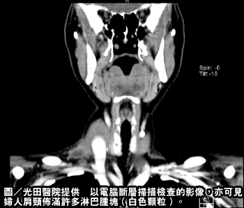 驚人！結核菌作祟　肩頸摸出數十顆腫塊猶如粽串