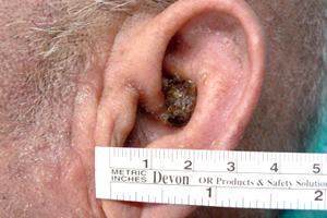 耳廓長痘痘竟是耳癌　旋轉門皮瓣重建無損外觀