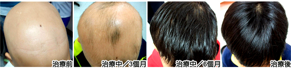 脾氣暴躁九歲童　頭髮掉光成沙彌