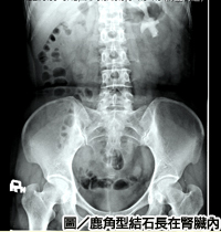 老婦背痛難耐　鹿角型結石惹禍！