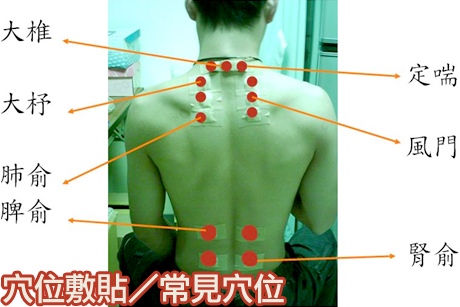 夏季調理過敏性鼻炎氣喘的好方法三伏貼