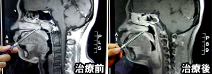 年經家庭主婦罹患鼻咽癌　銳速刀放射治療癌細胞不見了