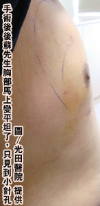 我的胸部比女友大？B罩杯帥哥縮乳展雄風