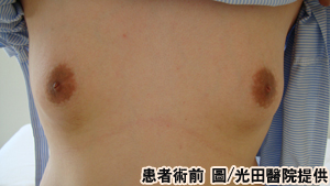 我的胸部比女友大？B罩杯帥哥縮乳展雄風
