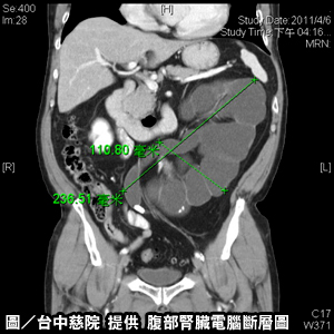 輸尿管結石　腎臟成水球