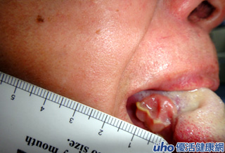 注意！口腔破洞逾2禮拜未癒合　當心舌癌上身