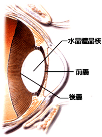 眼疾患者救星　人工水晶體解救白內障之苦