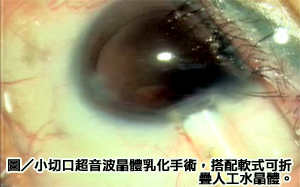 眼疾患者救星　人工水晶體解救白內障之苦