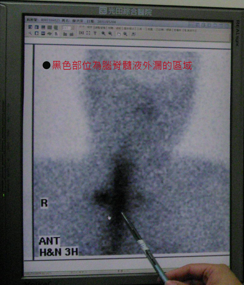 女子只敢躺不敢站！　腦脊髓液外漏惹禍