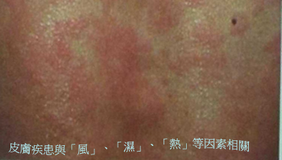 夏季皮膚好癢起疹　中醫內服藥、藥膏雙管齊下