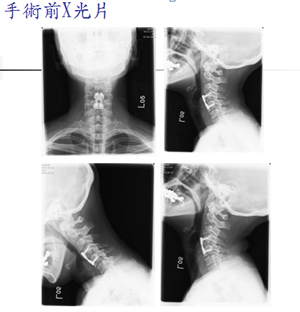 女導遊頸椎間盤突出動手術　鄰近骨關節退化