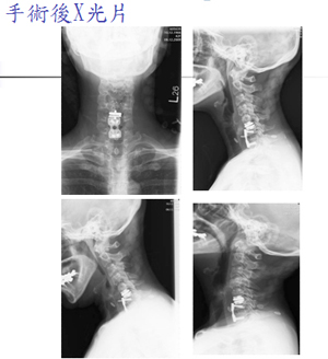 女導遊頸椎間盤突出動手術　鄰近骨關節退化