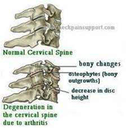 女導遊頸椎間盤突出動手術　鄰近骨關節退化