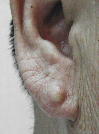 耳朵長粉瘤　拿不下來的珍珠耳環