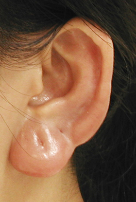 耳朵長粉瘤　拿不下來的珍珠耳環