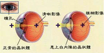 婦罹白內障10年近全盲　術後視力大大恢復