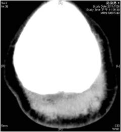 夏日氣溫過熱　慢性病患小心眩暈導致意外