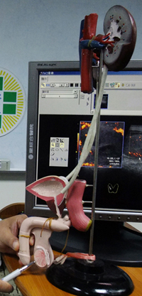 糖尿病併發症　60歲翁睪丸感染化膿