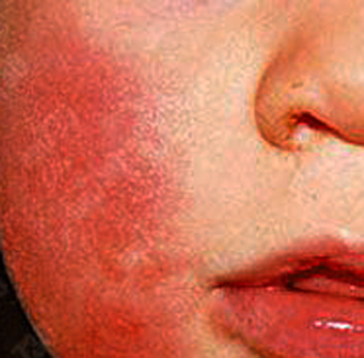 童雙頰如打耳光般紅疹　當心第五病