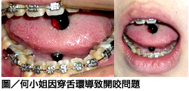17歲少女戴舌環導致開咬問題　中華牙醫學會籲：口腔健康一生健康！