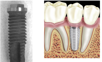 牙科電腦數位化來臨　人工植牙更精確