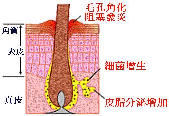 解決面子問題　中醫藥治療青春痘