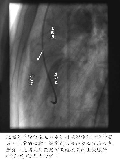 兒童心導管檢查找出心臟毛病　開刀治療