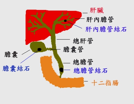 婦女肚子絞痛　口中吐出膽結石！