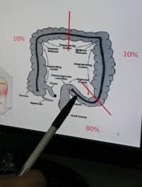 先天性巨結腸症　寶寶體內環保系統失調兇手