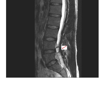 左腰臀部疼痛　男罹脊椎內腱鞘囊腫