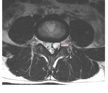 左腰臀部疼痛　男罹脊椎內腱鞘囊腫