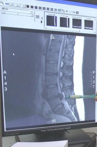 港商人下背痛　來台接受脊椎微創內視鏡椎間盤切除手術