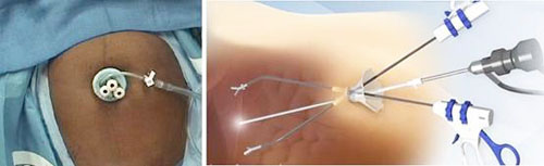 單孔腹腔鏡膽囊切除手術　恢復快、降疼痛感