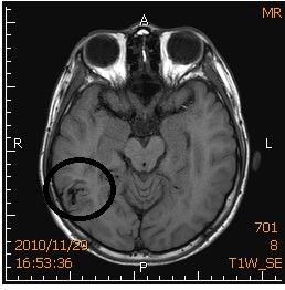 國中男頭痛、暈眩近一年　竟是動靜脈血管畸形