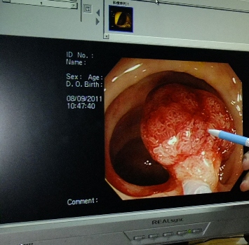 排便正常　竟罹患大腸癌第一期
