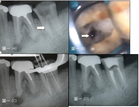 牙齒根管內斷裂器械處理　顯微根管治療