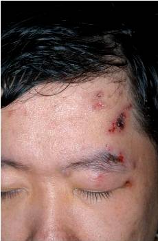 認識帶狀&#30129;疹　及時治療減少併發症