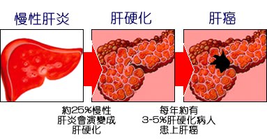 腹水、黃疸、下肢水腫　已是肝硬化晚期