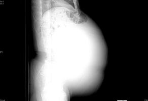 腹腫如大冬瓜　原是22公斤巨大卵巢瘤