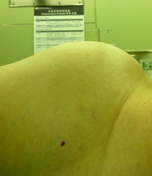 腹腫如大冬瓜　原是22公斤巨大卵巢瘤